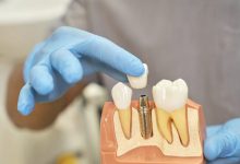 who-is-a-good-candidate-for-dental-implants?